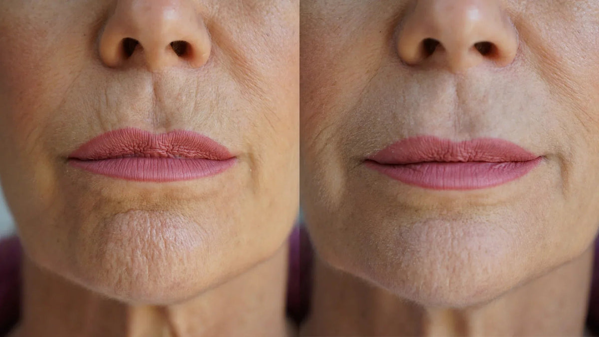 Diagram highlighting key problem areas treated by the Ageless Lip & Line Filler on face illustration.